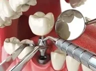 dental implant