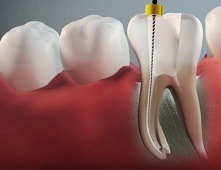 root canel treatment