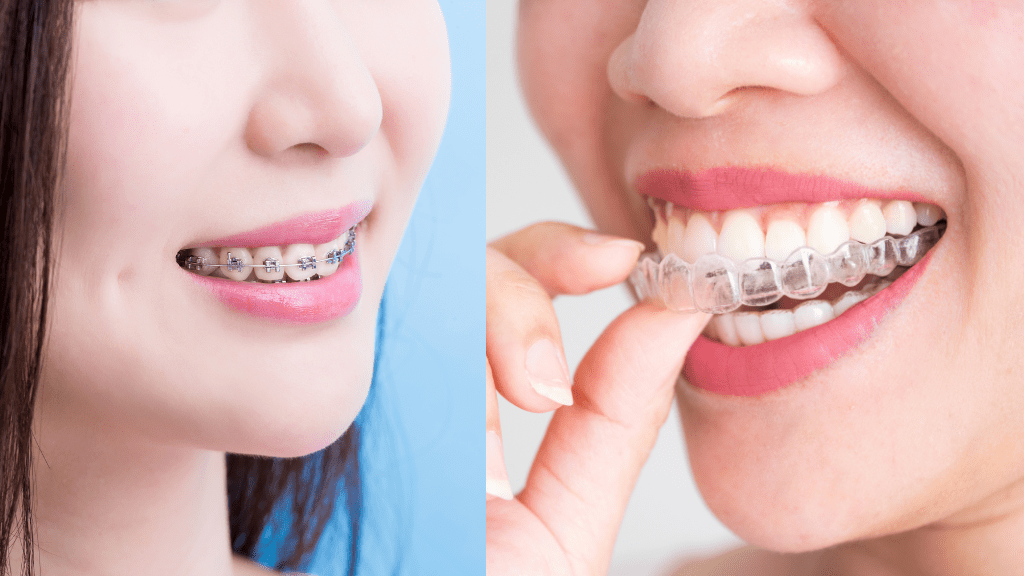 Braces vs Invisalign_ Which One is Right for You