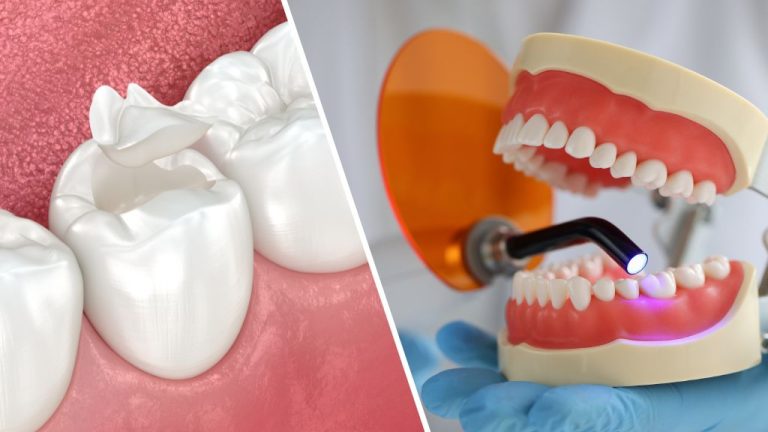 What Are Porcelain Dental Inlays and Outlays