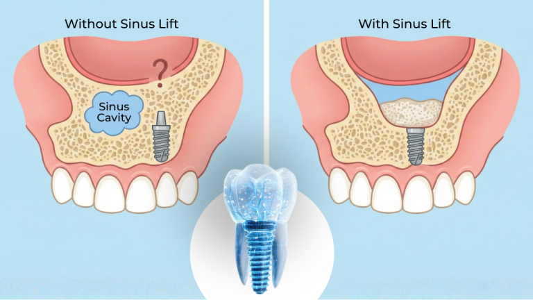 Sinus Lift to Get Dental Implants