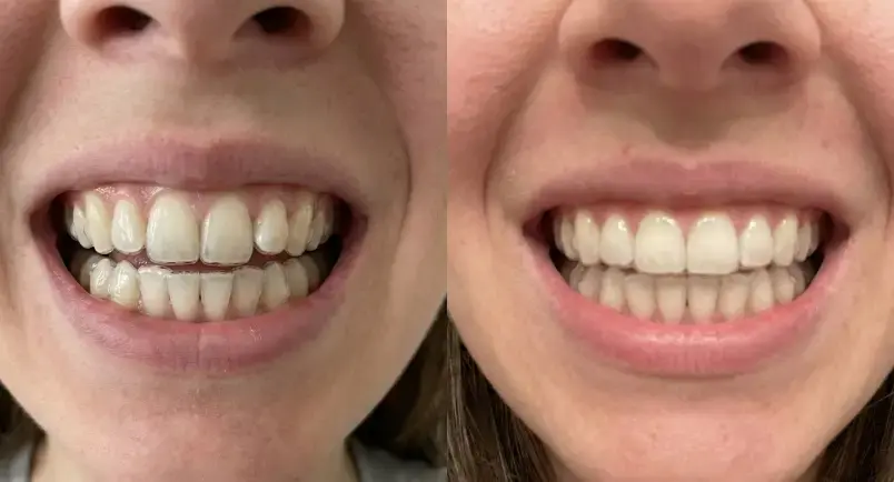 Before-and-after comparison of the treatment.